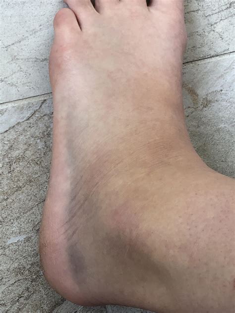 I rolled my ankle while running a couple days ago. On the first day, I