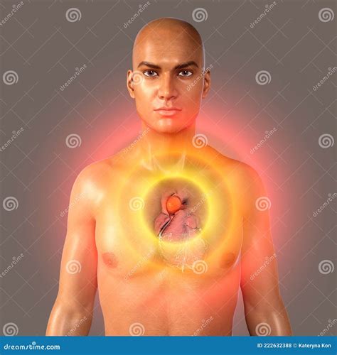 Aneurism Of Ascending Aorta Royalty-Free Illustration | CartoonDealer ...