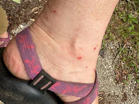 How to Treat Chigger Bites | Field & Stream
