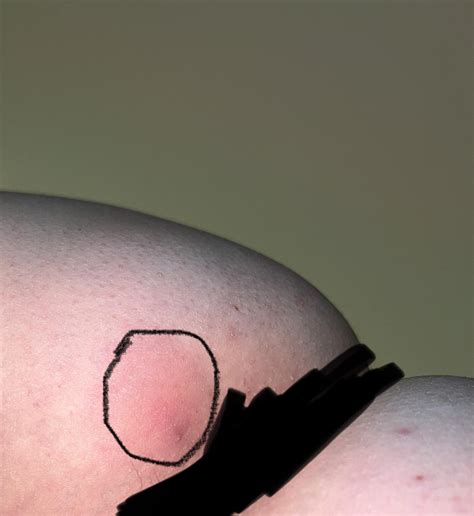 Painful bump on left buttocks. Pls help. Internet is making me cry with