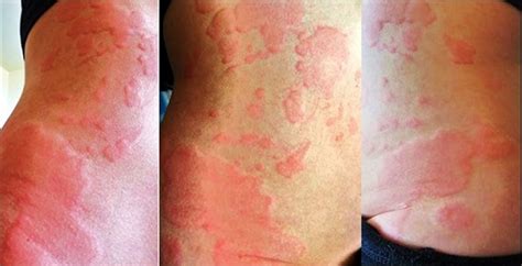 chronic urticaria chronic idiopathic urticaria  treatment