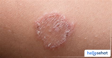 tinea corporis gejala penyebab hingga pengobatan