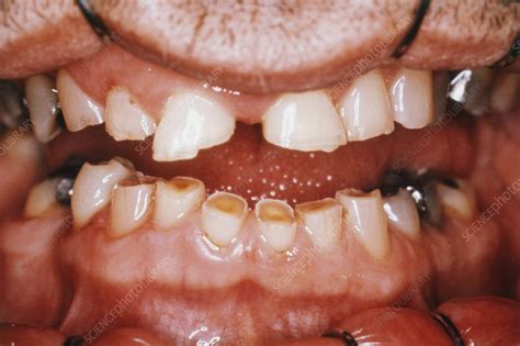 severe dental attrition stock image  science photo library