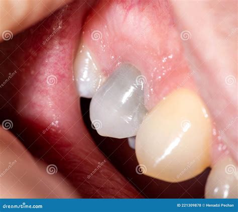 how to fix a gray tooth