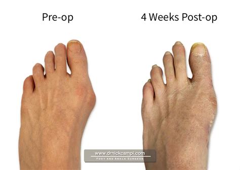 Minimally Invasive Bunion Surgery in Akron, OH | Dr. Nicholas