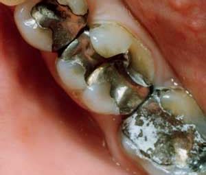 Removal of Amalgam Fillings Associated With Reductions in Memory Loss ...