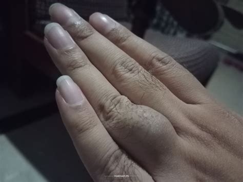 how to get a ring off a swollen finger 3