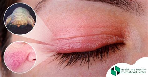Blepharitis - Whatare the symptoms of inflammation of the eyelids ...