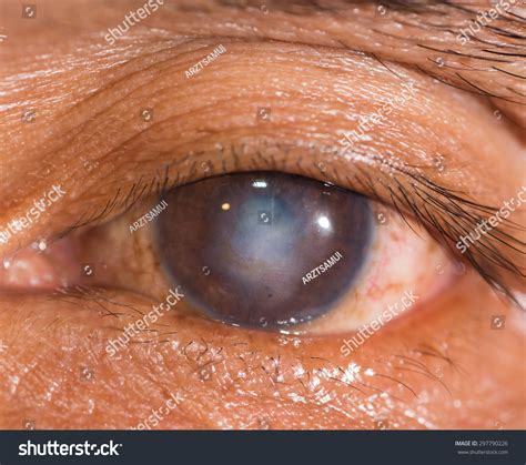 58 Corneal scarring Images, Stock Photos & Vectors | Shutterstock