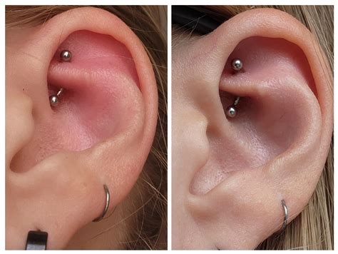 [UPDATE] PSA: it actually is possible to be allergic to titanium. More