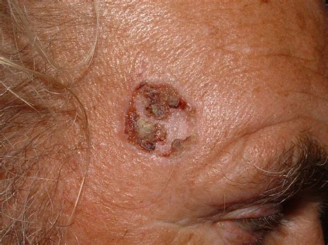 Photograph of a basal cell carcinoma of the forehead – Primary Care ...