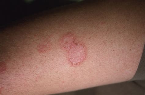 eczema rash circular  dustin richards blog