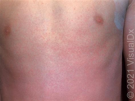 PA Diagnoses Drug Eruption with Help From VisualDx