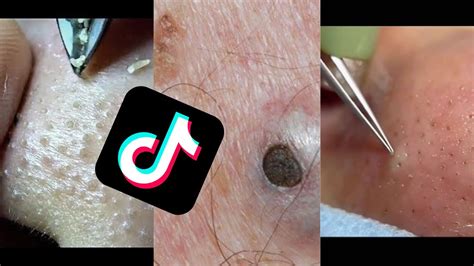 This Unbelievable Blackhead Removal 2024 Method is Taking Over TikTok! - v6d2rk0