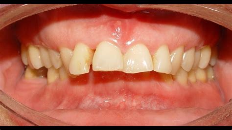Overbite