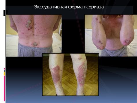 Презентация псориаз