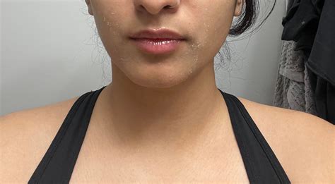 It’s dry flaky and embarrassing 😳 : r/tretinoin