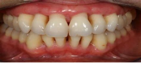 Symptoms of Ill-Fitting Dental Bridge- Causes, Treatment & Preventions