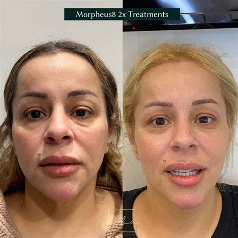 morpheus treatment biba cosmetic solutions
