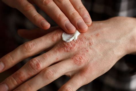 Psoriasis Treatment from a Dermatologist | Dermatology Associates of ...