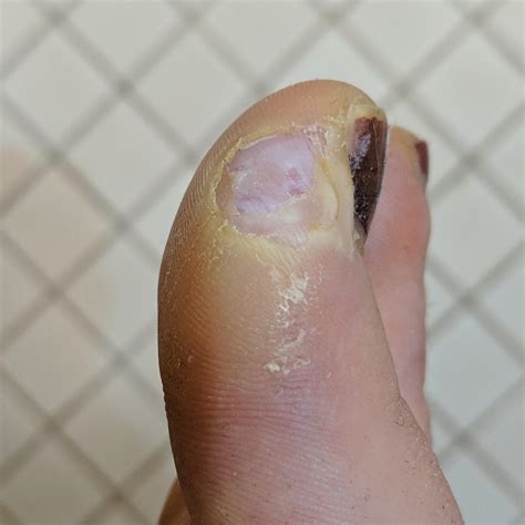 Also, side wart might be gone? What do you think? I just peeled some