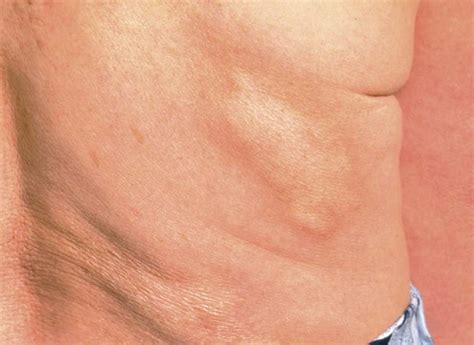 Morphea | Clinical Gate