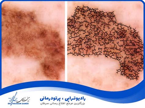 ملانوما چیست + علائم ملانوما + تشخیص ملانوما - دکتر حسن زندی