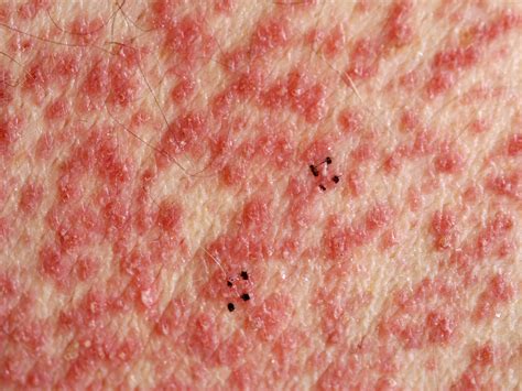 AGEP (acute gegeneraliseerde exanthemateuze pustulose)