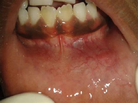 C: Healing of mucocele after cryosurgery. | Download Scientific Diagram