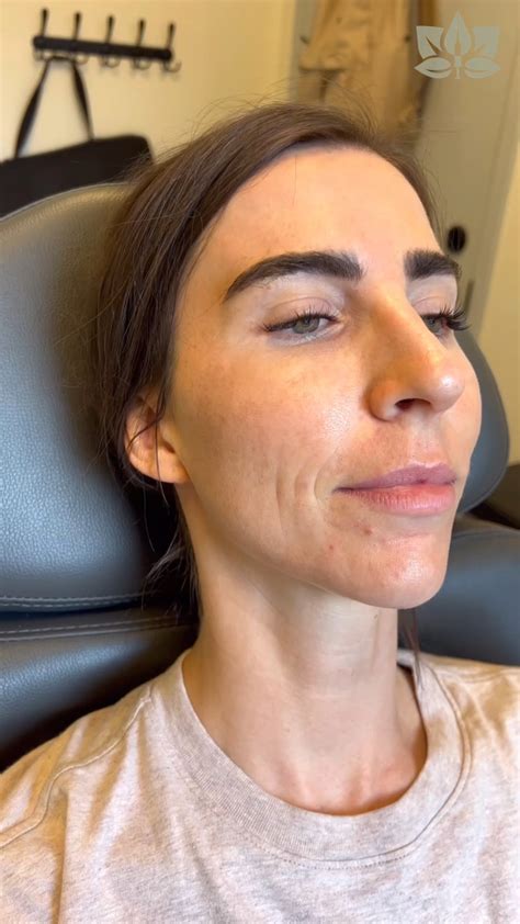 smile line filler review 5