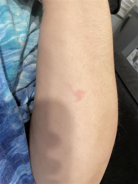 Is this a bite and burrow???? : r/scabies