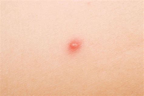 20 Ways to Get Rid of Zits and Prevent Breakouts
