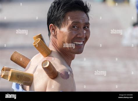 cupping therapy  res stock photography  images alamy