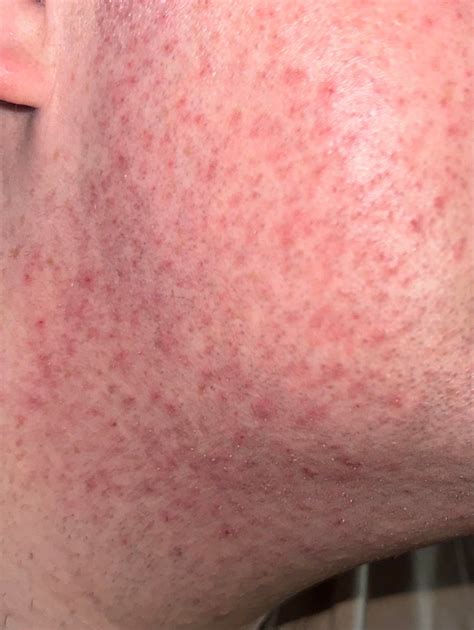 [Routine Help] How do I reduce the redness on my cheeks/side of face