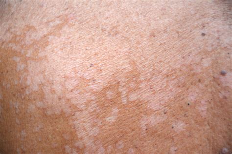 pityriasis versicolor tout savoir sur cette mycose cutanee