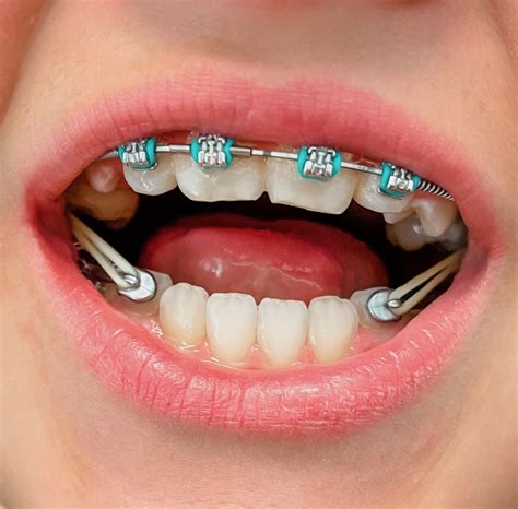 Why should you wear your rubber bands? - Best Orthodontics