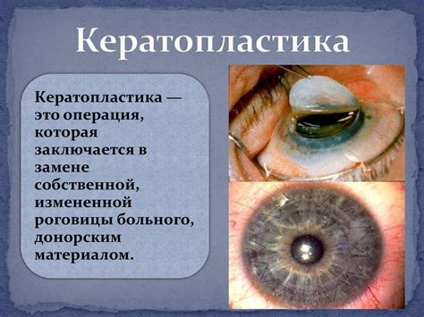 Операции на роговице - презентация онлайн
