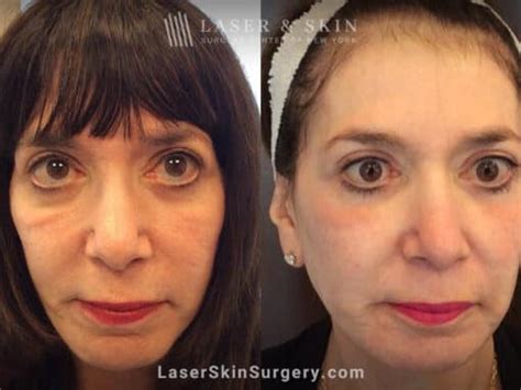 Festoons & Bags Under Eyes New York, NY | Laser Center