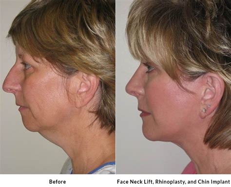 mini facelift  los altos ca trustworthy facial rejuvenation
