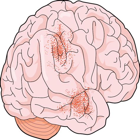 brain meningitis figure science figures