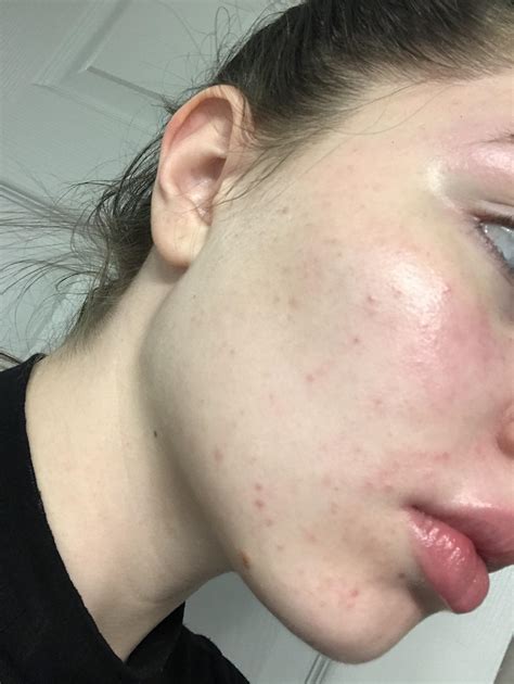 What Are The Little Red Bumps On My Baby's Face at Maria Elsberry blog