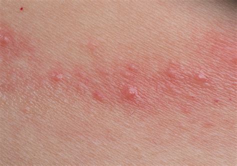Qu Es La Dermatitis De Contacto Sntomas Causas Y