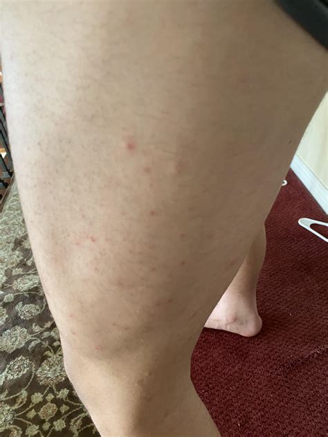 blackheads on back 1