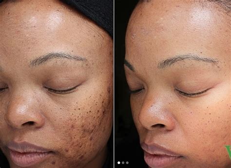 laser treatment qazi cosmetic center