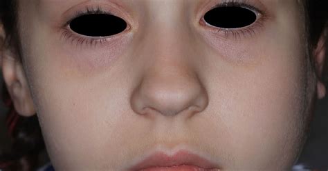 swollen face