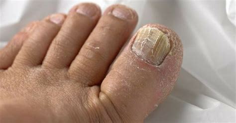Remedios caseros para hongos en los pies: 9 opciones
