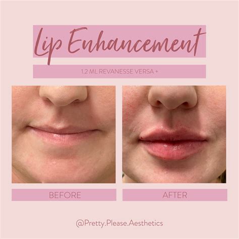 Lip Filler Swelling Before And After