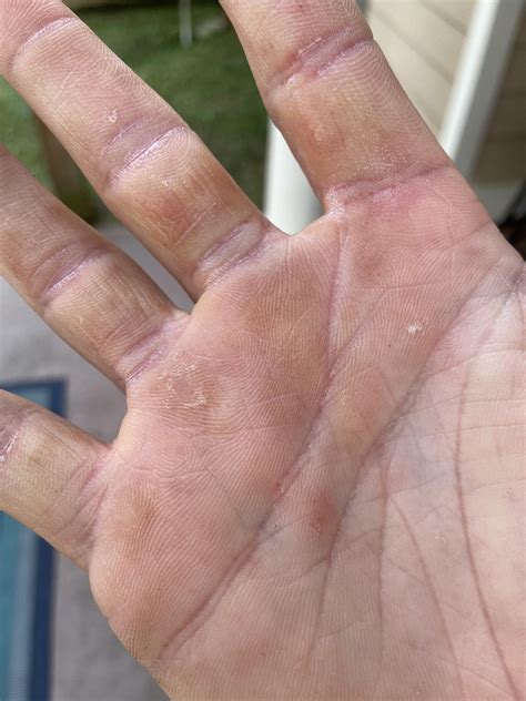 Do you guys think this is warts? It’s hard like calluses, but has black