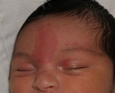 Mancha Marrom Na Pele Do Bebe - Manchas de nascença nos bebês: quando devo me preocupar