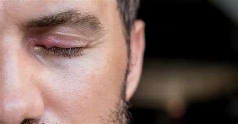 medications  swollen eye  guide  rely